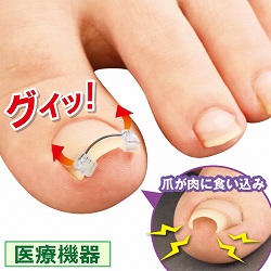 一般医療機器巻き爪ワイヤーガード